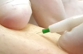 Hair Removal Staten Island