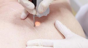 Permanent Hair Removal Staten Island